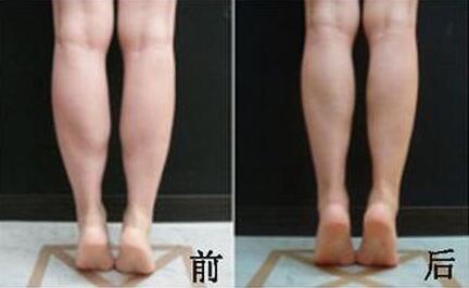 光纤溶脂瘦小腿适合哪些人？