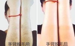 汪济广医生双眼皮做的好吗|汪济广割双眼皮案例硬核登场~ width=