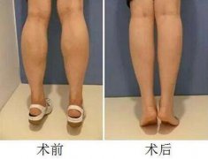 深圳瘦小腿大概多少钱？ width=
