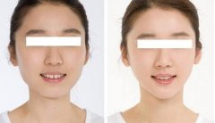 垫下巴费用多少钱？垫下巴费用贵不贵？ width=