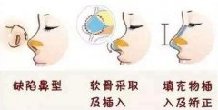 上海耳软骨垫鼻尖多少钱？ width=