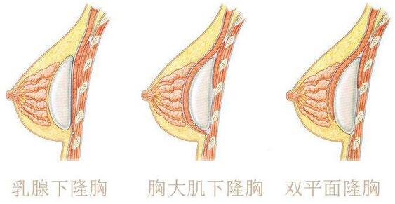 注射隆胸可以取出来吗
