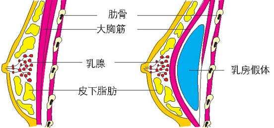 假体隆胸后果自然吗