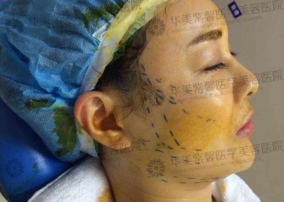 华美紫馨整形医院：47岁的ta整容190余次，只为变成明星！