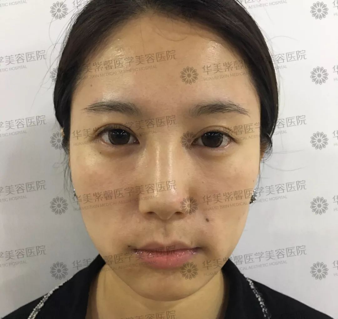 华美紫馨整形医院：47岁的ta整容190余次，只为变成明星！