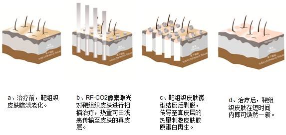 光子嫩肤维持时间是多久?
