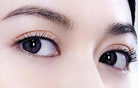 【肿泡眼可以做双眼皮手术吗？需要注意什么？】