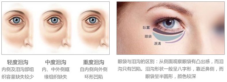 填充泪沟的两个整形方案
