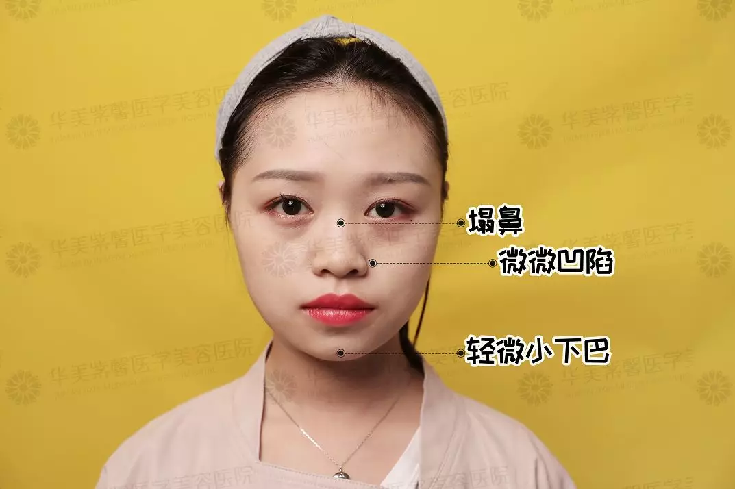 自体脂肪填充苹果肌、额头、下巴、眼窝的优势？谁来说说~