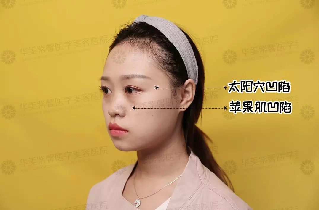自体脂肪填充苹果肌、额头、下巴、眼窝的优势？谁来说说~