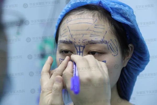 自体脂肪填充苹果肌、额头、下巴、眼窝的优势？谁来说说~