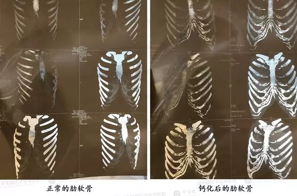 自体脂肪填充苹果肌、额头、下巴、眼窝的优势？谁来说说~