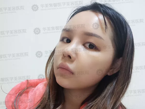 自体脂肪填充苹果肌、额头、下巴、眼窝的优势？谁来说说~