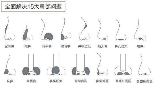 隆鼻假体植入的步骤