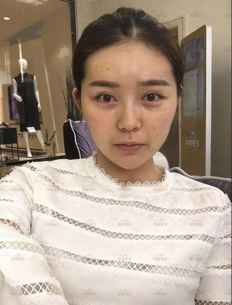 埋线提升提升+多方面部自体脂肪移植——摆脱凹凸脸，素颜也很美！