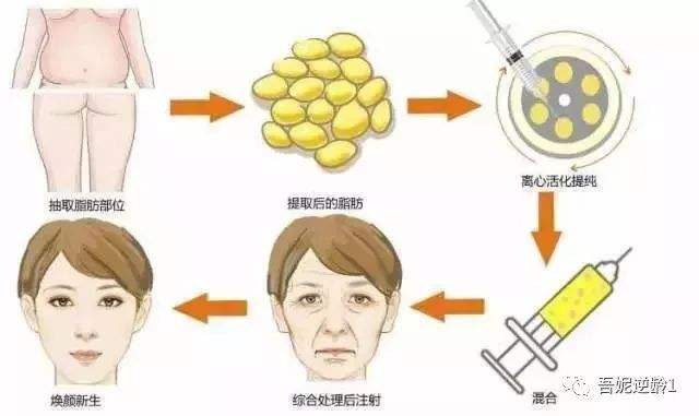 自体干-细胞移植除皱有这四个主要特点