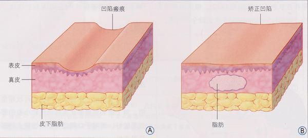 自体干-细胞移植除皱有这四个主要特点