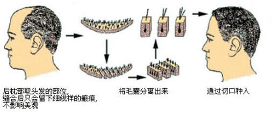 除了植发以外的发量稀疏拯救方法