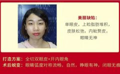 广州美恩陈宏斌全切双眼皮+开内眼角案例一枚分享~ width=