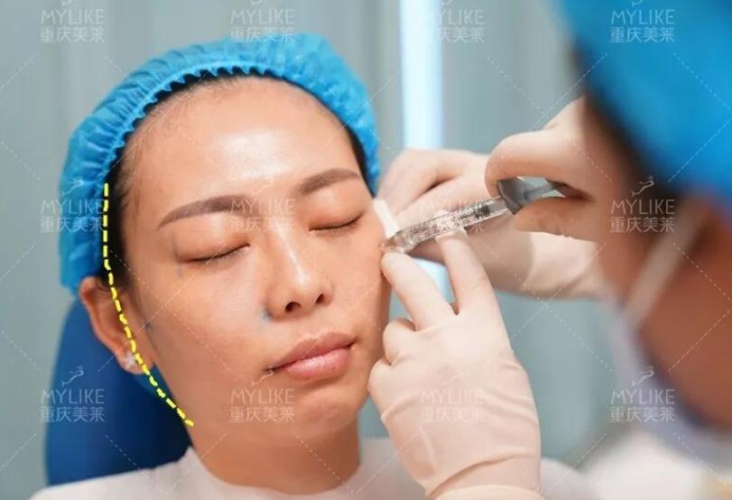磨颧骨前后对比图，颧骨整形有失败案例吗？