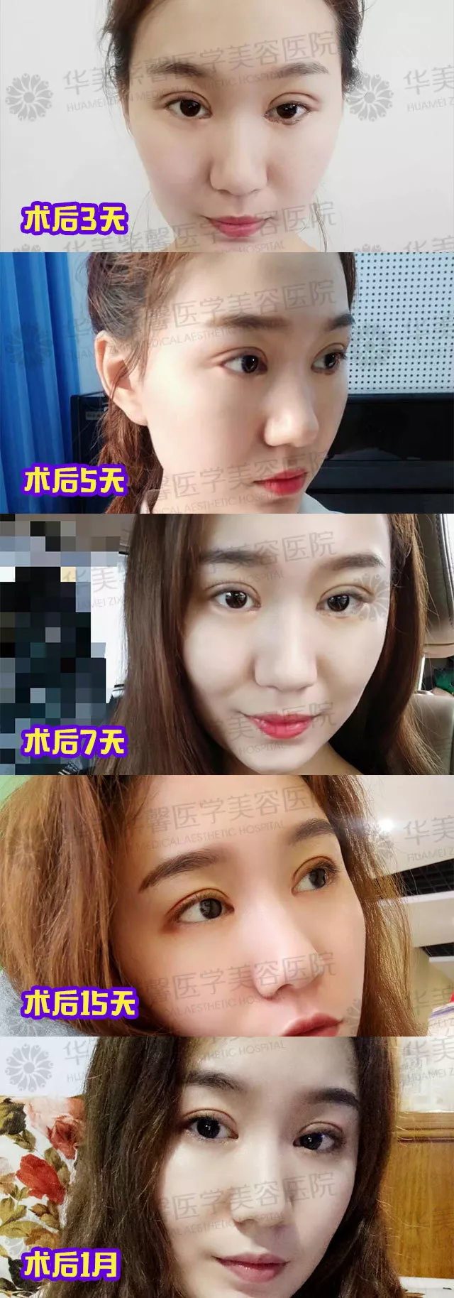 割双眼皮到底疼不疼？这个“鹦鹉人”较有发言权！ 