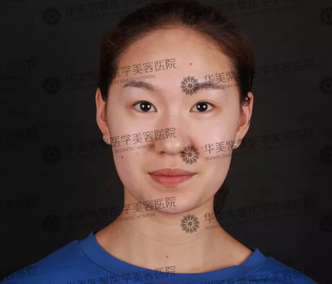 割双眼皮到底疼不疼？这个“鹦鹉人”较有发言权！ 