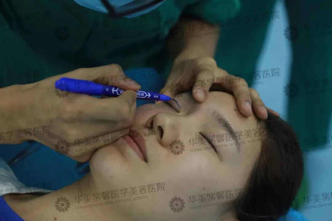 割双眼皮到底疼不疼？这个“鹦鹉人”较有发言权！ 