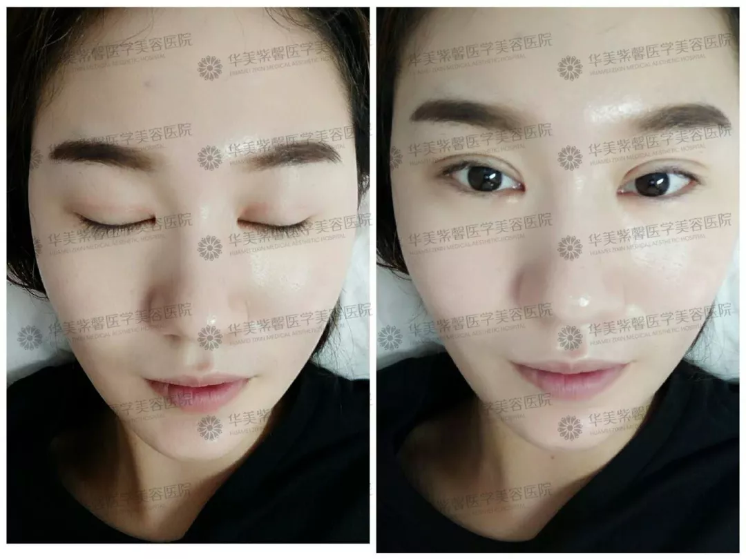 割双眼皮到底疼不疼？这个“鹦鹉人”较有发言权！ 