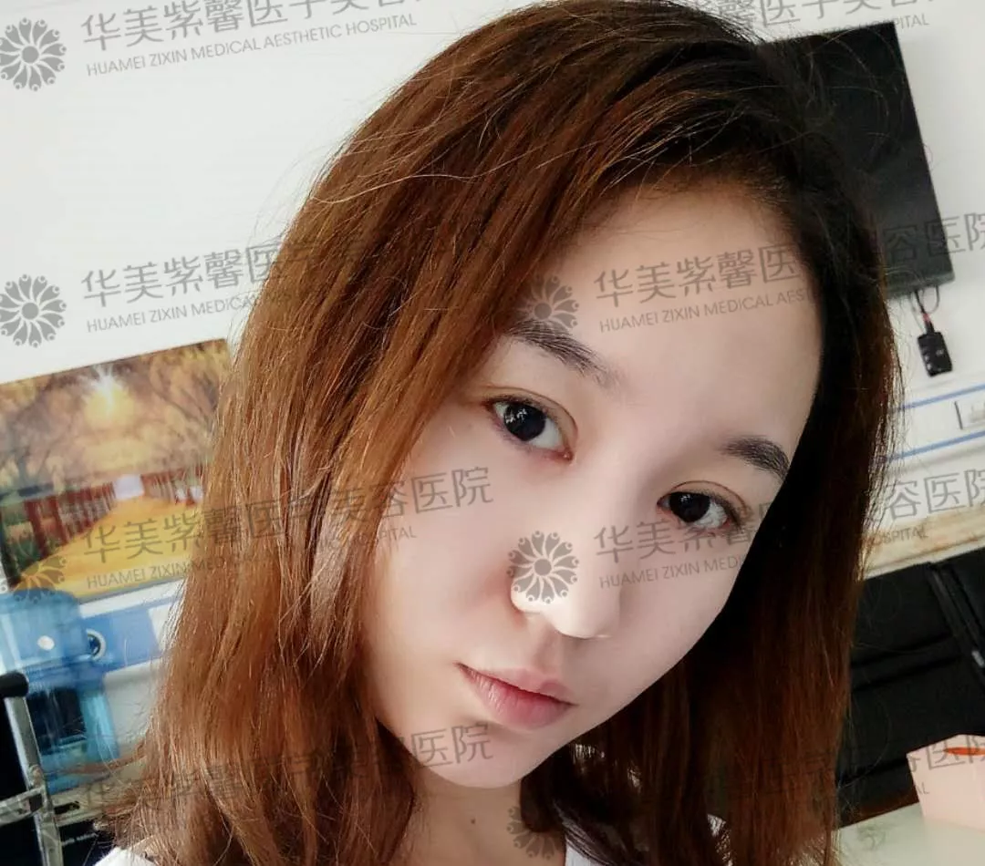 割双眼皮到底疼不疼？这个“鹦鹉人”较有发言权！ 