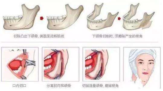 磨骨有副作用吗?存在哪些风险?