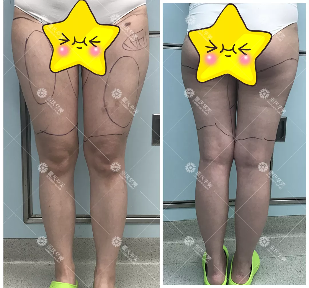 【节后减肥自救指南】吸脂瘦身又塑型，快速瘦美~