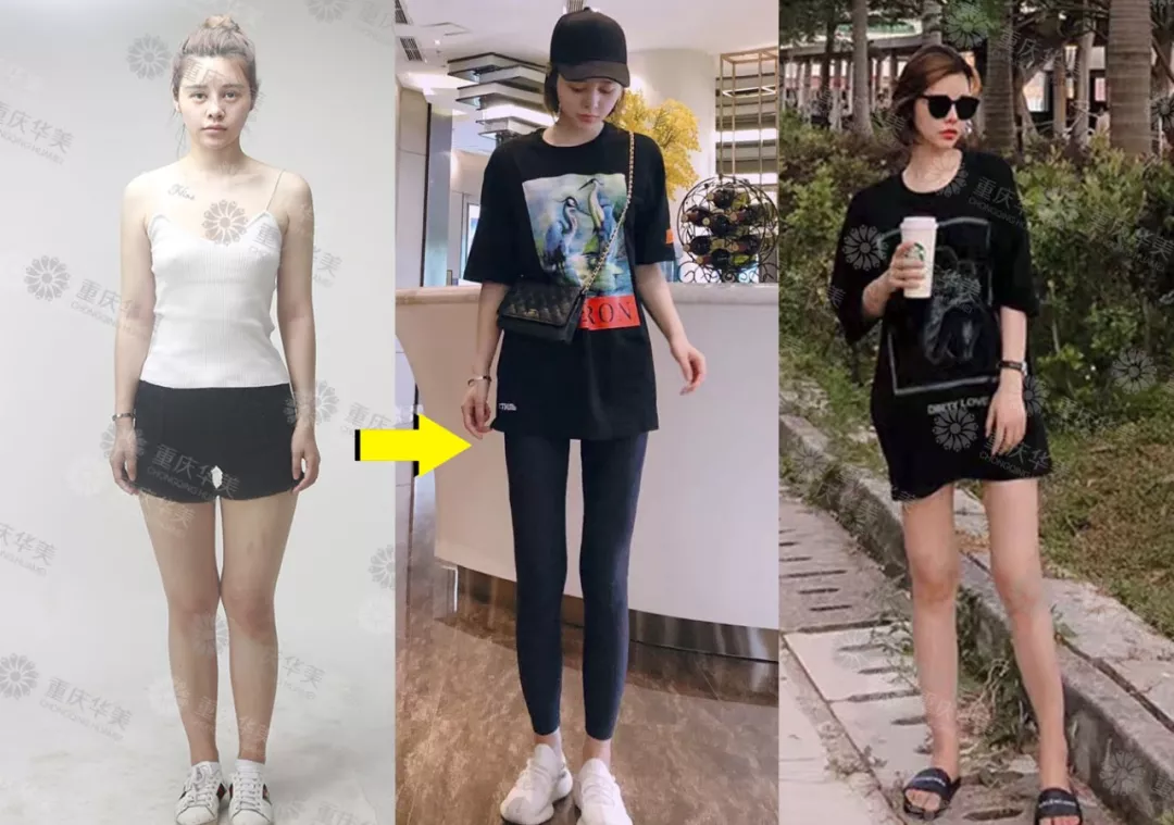 【节后减肥自救指南】吸脂瘦身又塑型，快速瘦美~