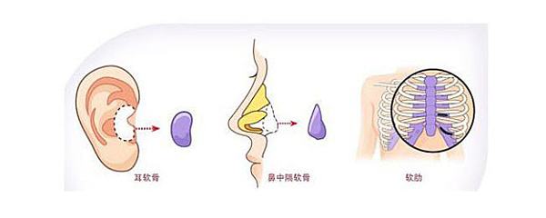 自体软骨隆鼻有哪几种?