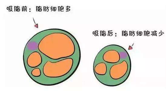 吸脂有哪些后遗症?