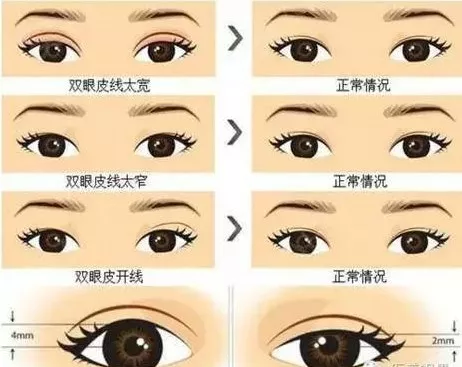 迅姐喜提热搜，到底双眼皮哪里出了问题？