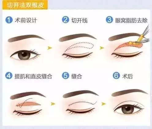 迅姐喜提热搜，到底双眼皮哪里出了问题？