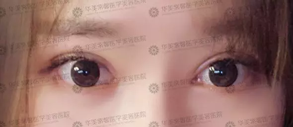 华美紫馨急速纳米美眼案例一则发出来给你们瞧瞧~ width=