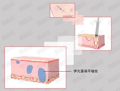 注射伊维兰除皱有后遗症吗?