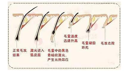 月经在的时候能做激光脱毛吗