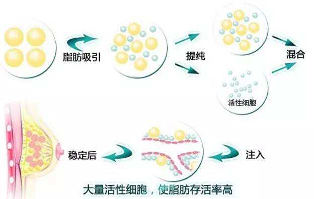 自体脂肪多了没用?那是没放对地方!
