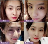 到底什么是“Eyestar星眸动态双眼皮”夏院长亲自为您解答！ width=