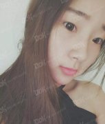 成都铜雀台综合美眼案例一枚——重睑、内眦、翘睫一步到位~ width=