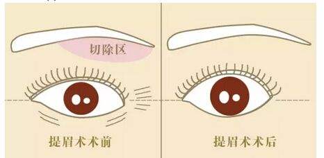 双平面提眉术果图
