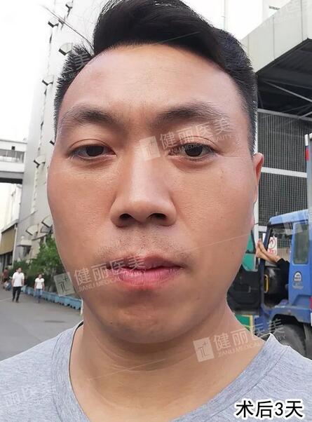 37岁大叔分享:7年眼袋 泪沟,30分钟就解决了!