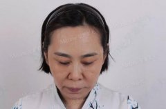 星源美天院长做面部除皱抗衰案例，大姐年轻了好多！ width=
