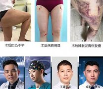 360度环形吸脂减肥到底好不好喃？一分钟之内我要听到答案！ width=