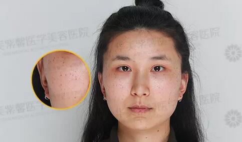 【祛斑后反黑，只有3%的人用对了方法！】