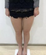 4S多维立体吸脂果很腻害哇？这里有个案例给你看！ width=
