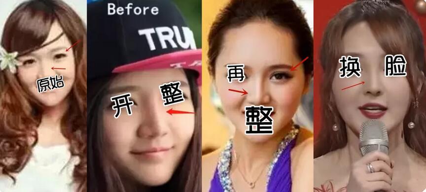 自体耳软骨垫鼻尖的果如何，这篇文章看似能给你答案哟！