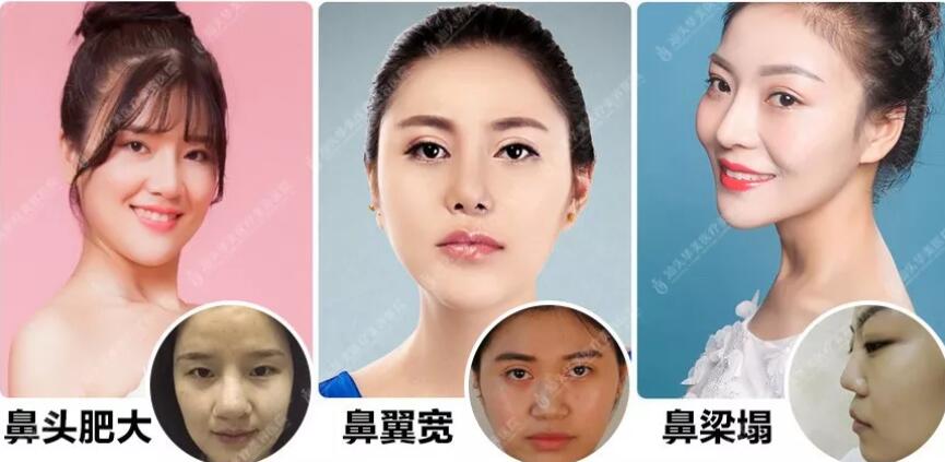 自体耳软骨垫鼻尖的果如何，这篇文章看似能给你答案哟！